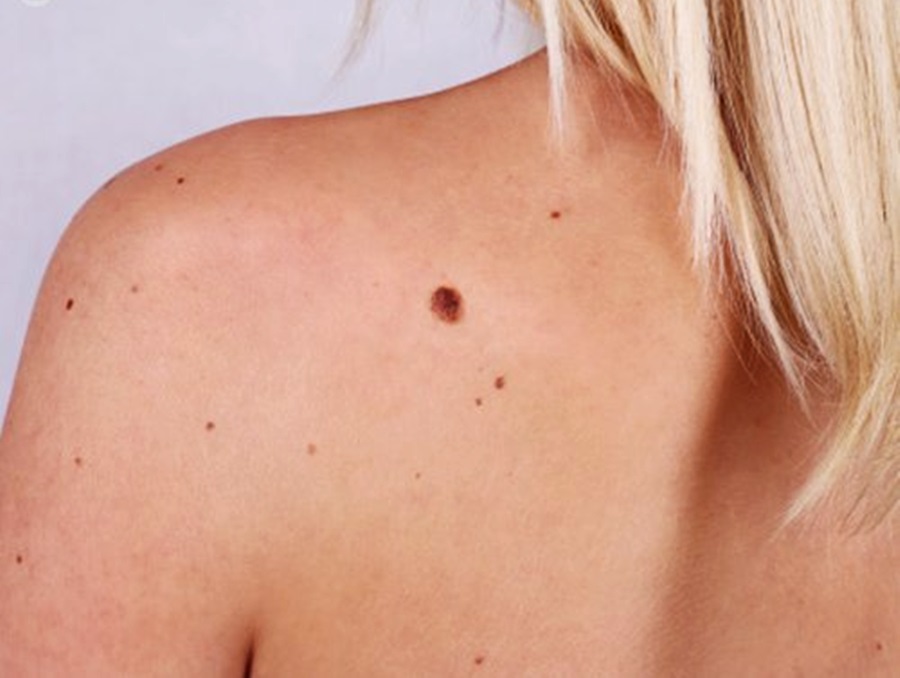 Lesões podem ser sinal de câncer de pele